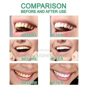 7-days-teeth-whitening-big-1